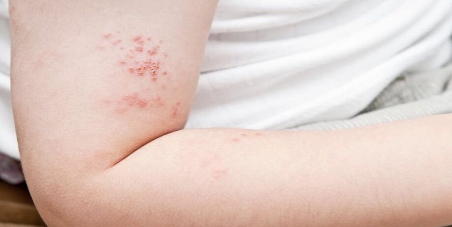 Do you know which Age Group had the Greatest Herpes Zoster Incidence Rates?